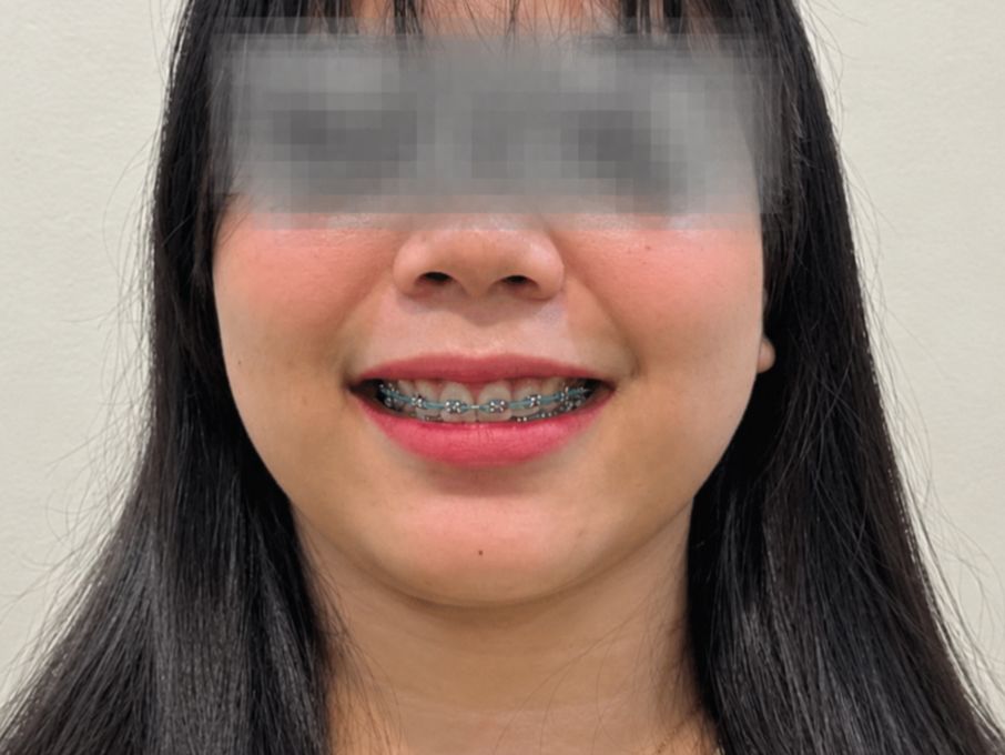 Ortodontik sesudah