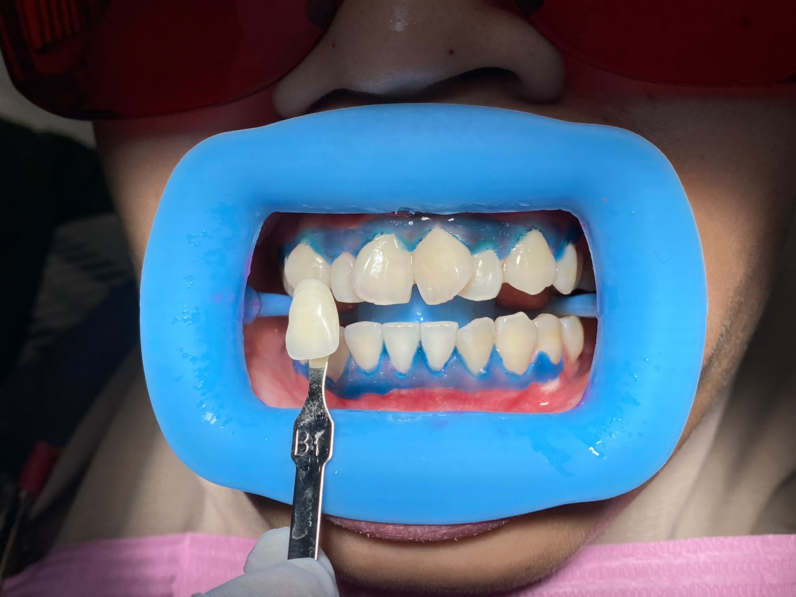 Bleaching Gigi sesudah