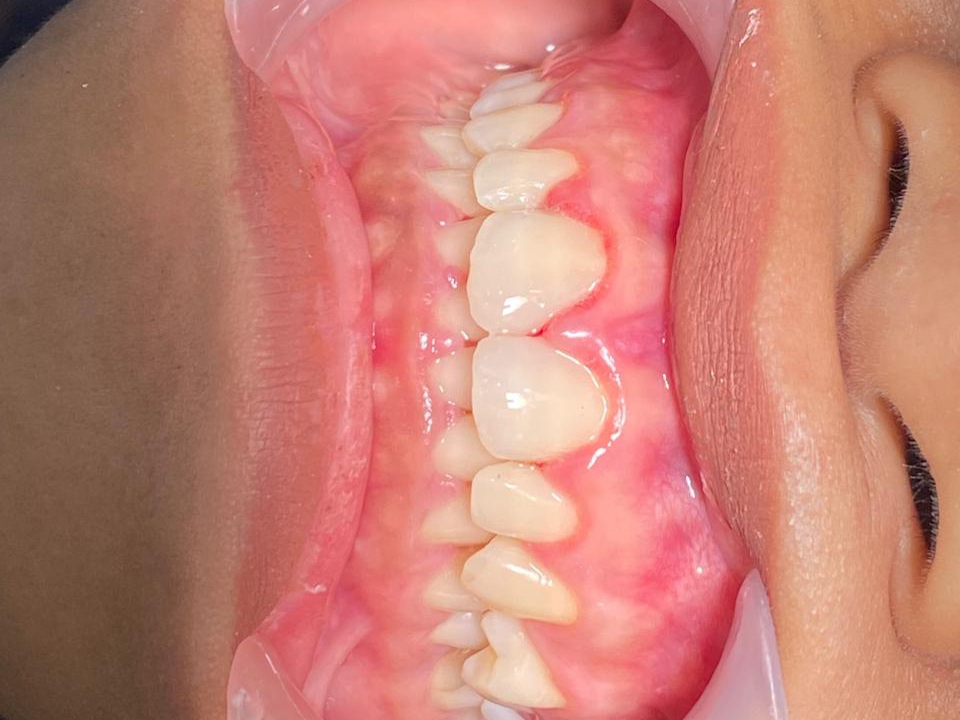 Diastema Closure sesudah