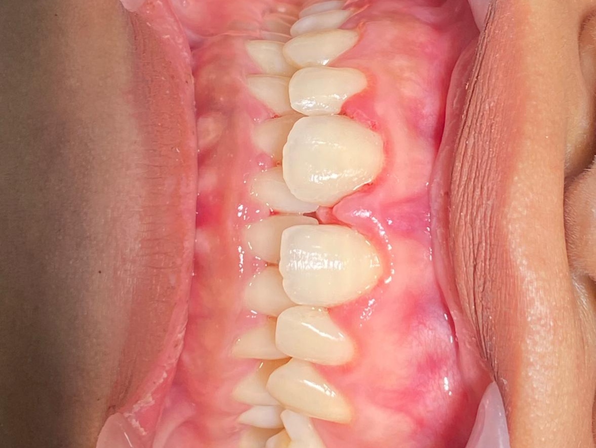 Diastema Closure sebelum