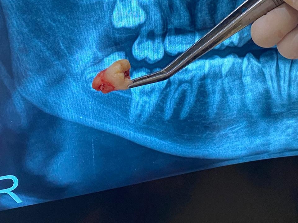 Cabut Gigi di Sky Dental Care Jambi